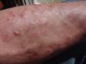 morgellons lesions