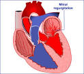 Mitral Regurgitation | Medindia