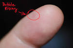 <b>Dyshidrotic Eczema</b>