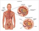 <b>Lymphoma</b> - symptoms and