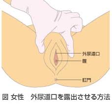 女尿道口|スキーン腺 - Wikipedia