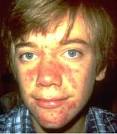 Face Acne Treatment