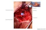 <b>Accessory Nerve</b> Transfer