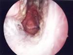 A report on a rare case of Klebsiella ozaenae causing atrophic