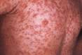 Three babies diagnosed with measles in Sydneys west.