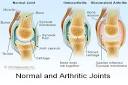 While <b>rheumatoid arthritis</b> is