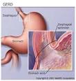 GERD Causes and Complications: Esophagitis, Asthma, Cancer, and More