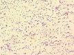 Brucellosis - Wikipedia, the free encyclopedia