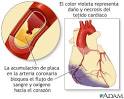 <b>infarto</b>_del_<b>miocardio</b>.jpg