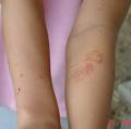  Rash Pictures - most from contact with poison ivy, poison oak, or ... 