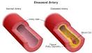 Coronary Artery Disease - Thomas Jefferson University Hospitals