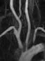 <b>Aortic arch syndrome</b>