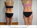 Exilis Uses Monopolar Radio Frequency to Contour the Body