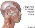 <b>tension</b>-<b>type</b>-<b>headache</b>.jpg