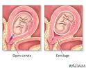 Special-care pregnancies - Cervical Insufficiency