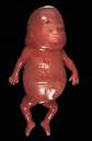 Definition of «Hydrops fetalis