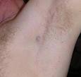 Malignant Melanoma Stories: Glen's Story