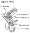 Indirect inguinal hernia - Wikipedia, the free encyclopedia