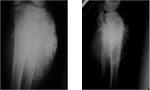 X-RAY: Large <b>Osteosarcoma</b>