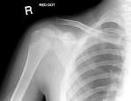 Proximal <b>humeral fractures</b>