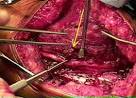 Radial Nerve Palsy following Frx of the Humerus - Wheeless ...