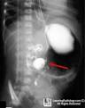 LearningRadiology.com - Malrotation,