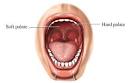 <b>palate</b>