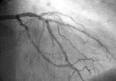 Angioplasty - Wikipedia, the free encyclopedia