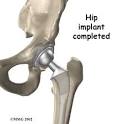 A Patient's Guide to Artificial Joint Replacement of the Hip