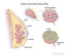 <b>Lobular carcinoma</b> in situ