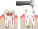 Root Canal Treatment - Start Curing Your Tooth Decay - Cure Tooth ...
