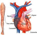 <b>Arteriosclerosis Coronaria</b>