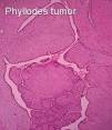 phyllode breast tumor