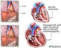 Alcoholic cardiomyopathy -