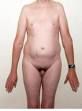Klinefelter's Syndrome- XXY