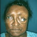 fibrous dysplasia) is a