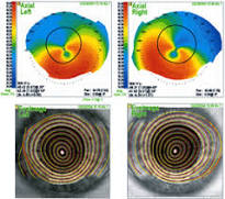 Ceratocone, ectasia, ectasia corneal, ectasia corneana, tratamento para ceratocone, cura para ceratocone, ceratocone avançado, ceratocone inicial, suspeita de ceratocone, lente para ceratocone, especialista em ceratocone, especialista ceratocone porto alegre, clinica especializada em ceratocone, oftalmologista ceratocone, oftalmologista para ceratocone, especializado em ceratocone, cone, córnea fina, cornea fina, córnea em forma de cone, cornea em forma de cone, ceratocone tratamento, ceratocone cirurgia, crosslink, cross link, crosslinking, cross linking, anel de ferrara, transplante de córnea, transplante de cornea