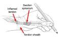 <b>De Quervain</b> tenosynovitis of