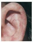 <b>Ataxia Telangiectasia</b>