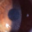 Reis–Bucklers corneal dystrophy - Wikipedia, the free encyclopedia