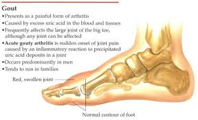 Foot Gout Pain