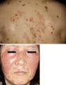A Case of IgG/IgA Pemphigus