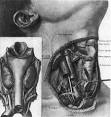 The Effects Of Fluoride On The Thyroid Gland