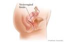 is a <b>vaginal fistula</b> that