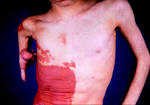 <b>ichthyosiform erythroderma</b>