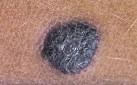 Also called Reed's <b>nevus</b>