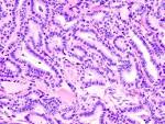 <b>papillary carcinoma</b>