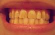 Bruxism - Wikipedia, the free encyclopedia