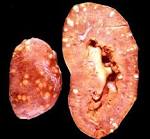 <b>Renal tuberculosis</b>.