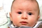 File:<b>Infant</b> with blepharitis